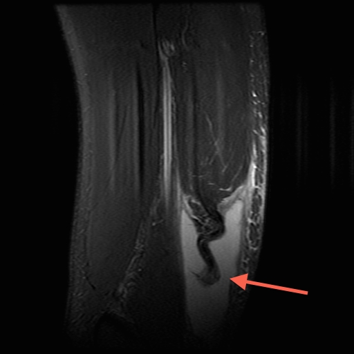 Figure 4 for case Rupture of bi-fid distal biceps tendon